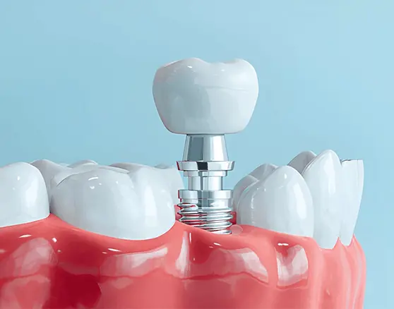 Dental Implants at Dharma Dental